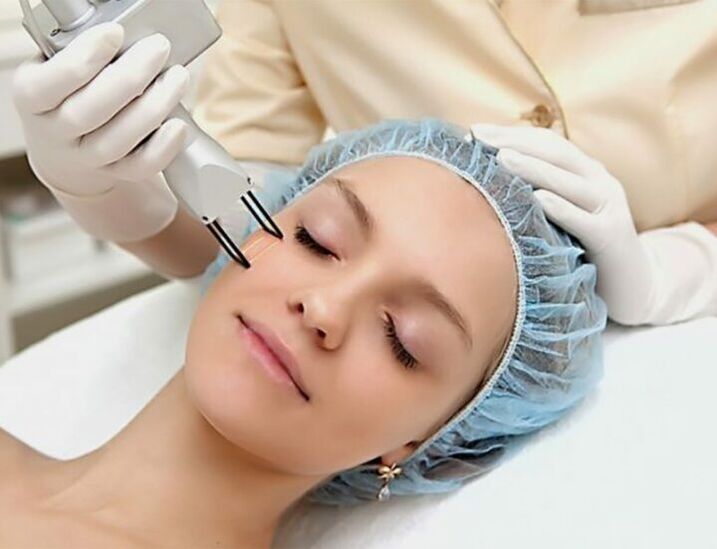 Djelomično lasersko djelovanje na kožu lica u svrhu nježnog pomlađivanja