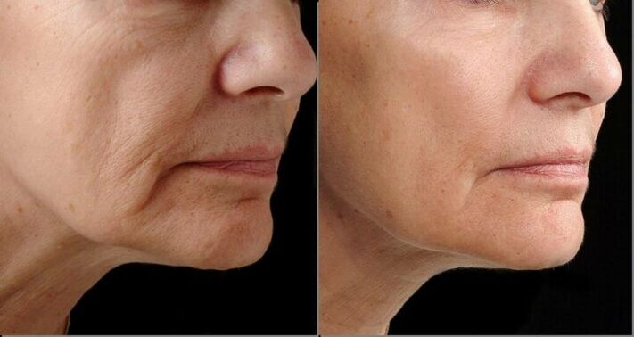 Koža lica prije i poslije postupka pomlađivanja laserom