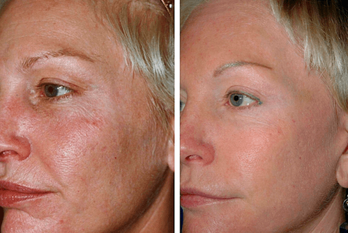 slika prije i poslije frakcijskog pomlađivanja kože 1