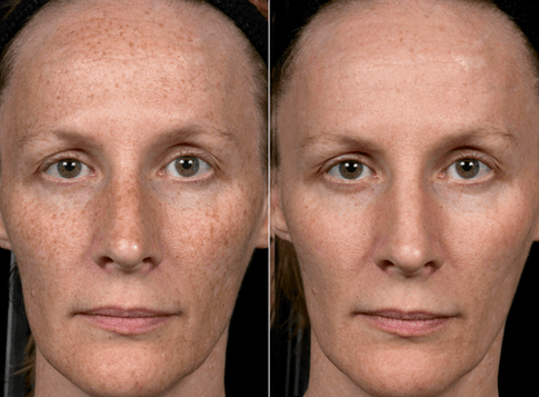 slika prije i poslije frakcijskog pomlađivanja kože 3