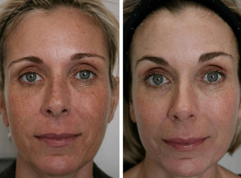 slika prije i poslije frakcijskog pomlađivanja kože 4