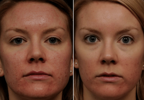 slika prije i poslije frakcijskog pomlađivanja kože 6