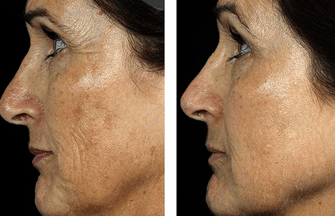 slika prije i poslije frakcijskog pomlađivanja kože 7