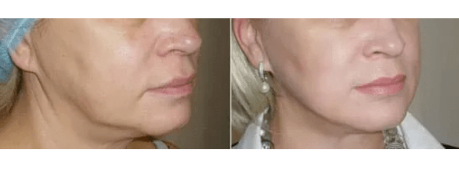 oporavak nakon pomlađivanja kože