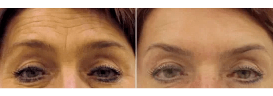 uređaji za frakcijsko pomlađivanje