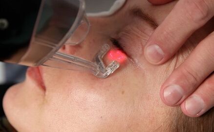 laserski postupak pomlađivanja kože lica
